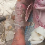 EN MOLINOS-JAUJA: ABUELITA SUFRE QUEMADURAS, AL CAERLE AGUA HIRVIENDO