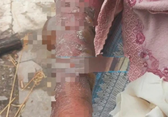 EN MOLINOS-JAUJA: ABUELITA SUFRE QUEMADURAS, AL CAERLE AGUA HIRVIENDO