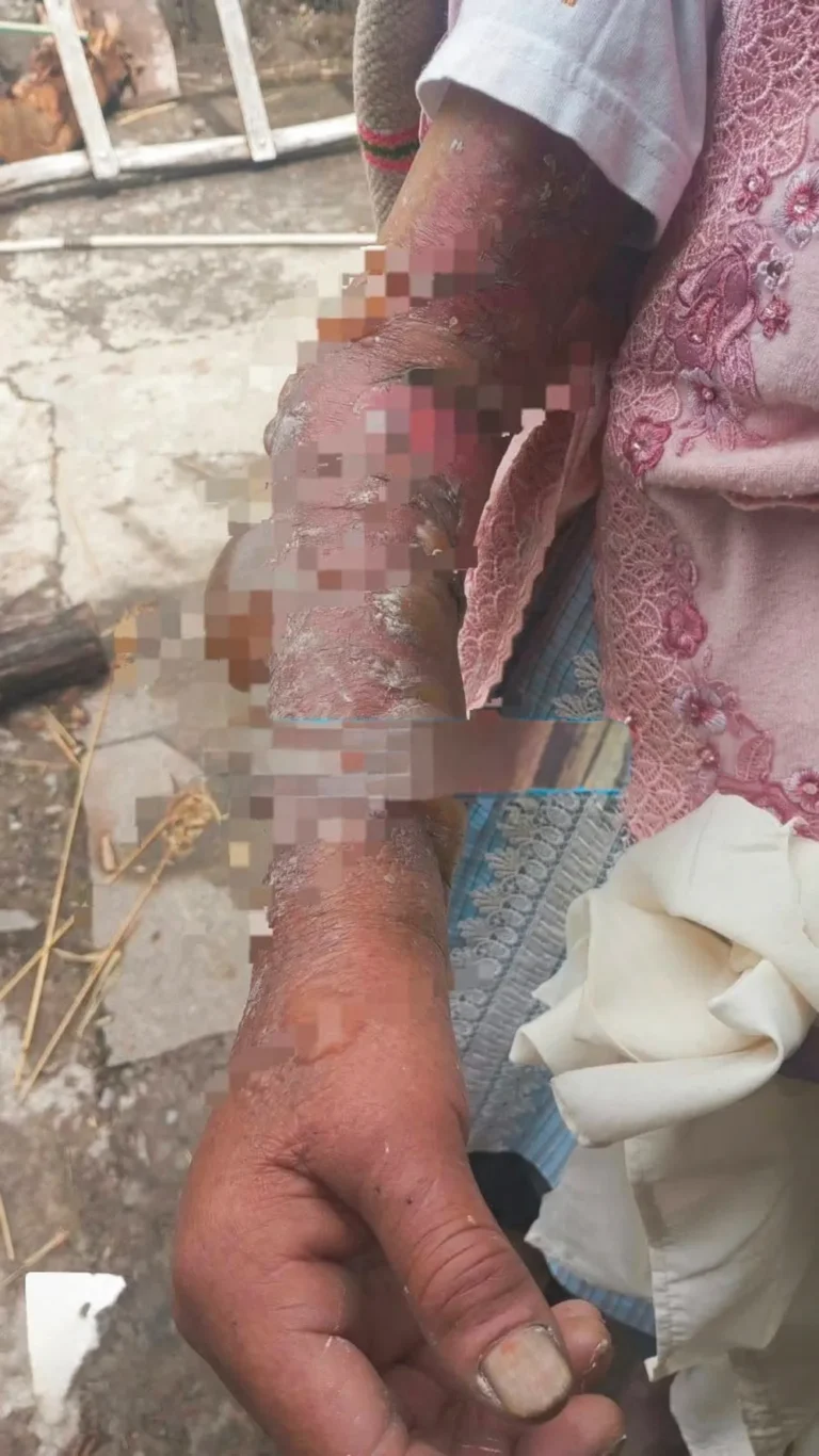 EN MOLINOS-JAUJA: ABUELITA SUFRE QUEMADURAS, AL CAERLE AGUA HIRVIENDO
